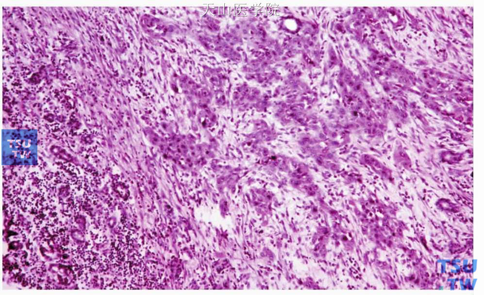 鳞状细胞癌：肿瘤细胞呈小巢状浸润