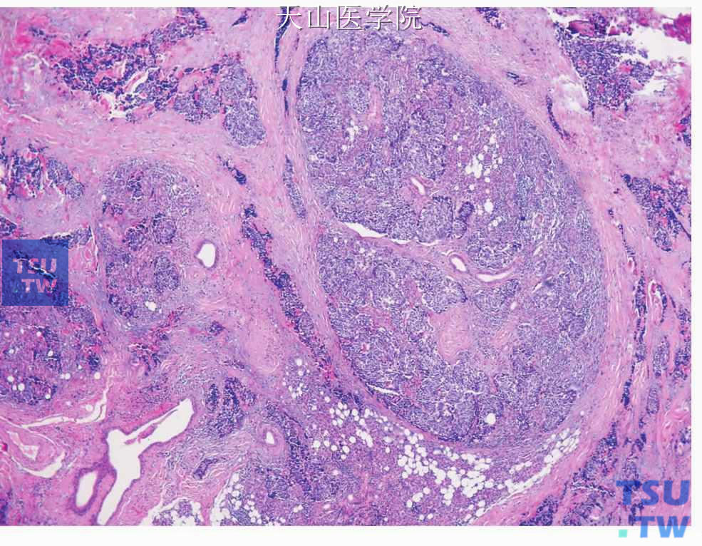 小细胞癌：肿瘤在腺体内形成大小不等的团，浸润性生长