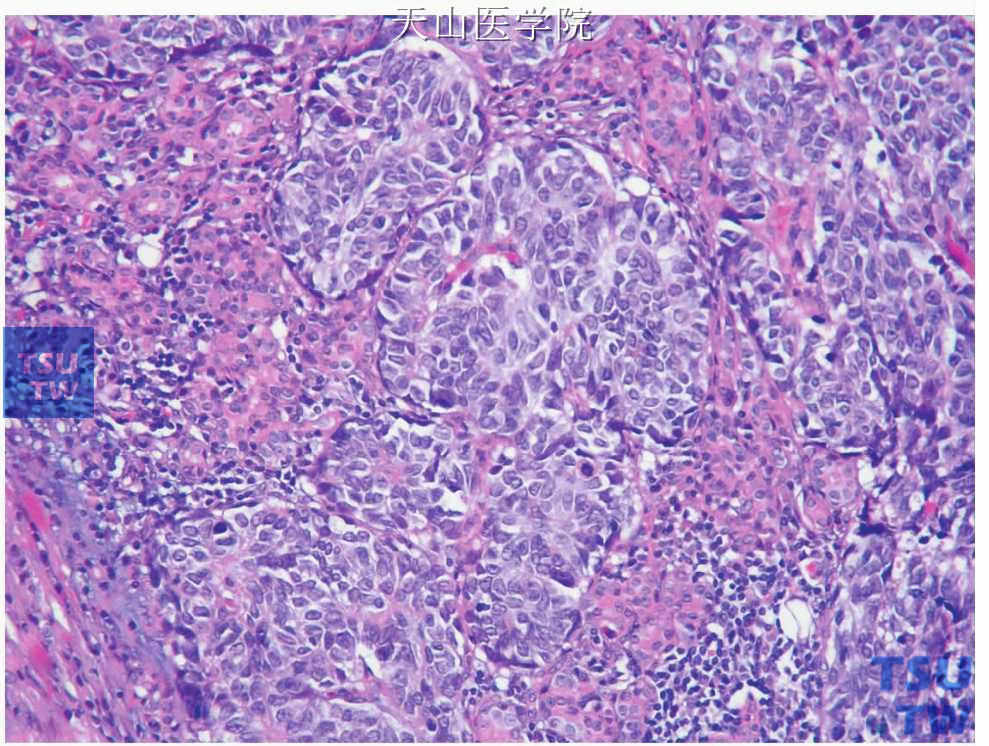 小细胞癌：肿瘤细胞团块浸润腺体实质