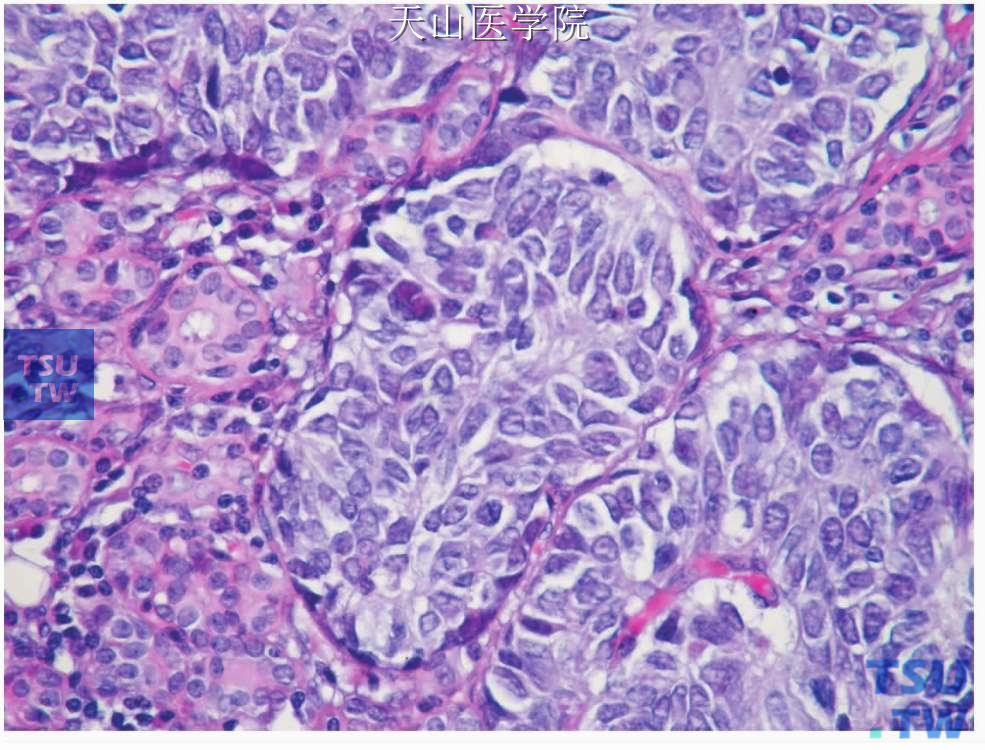 小细胞癌：肿瘤细胞椭圆形至梭形，核质比例大，胞质少