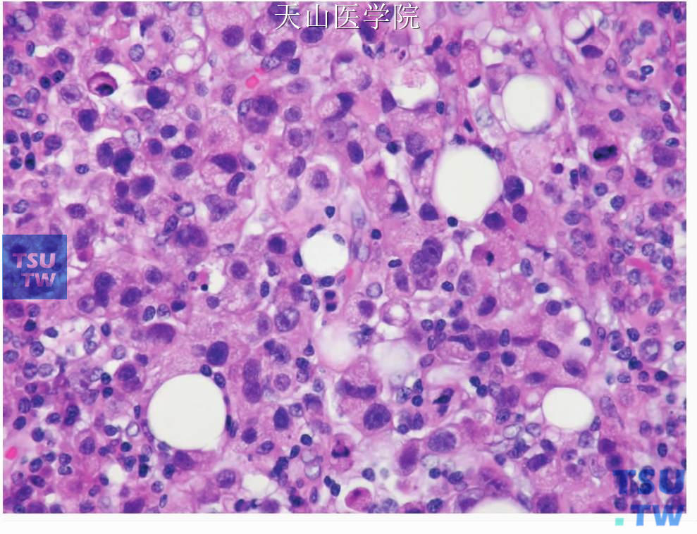 大细胞癌：肿瘤细胞分散，似淋巴瘤