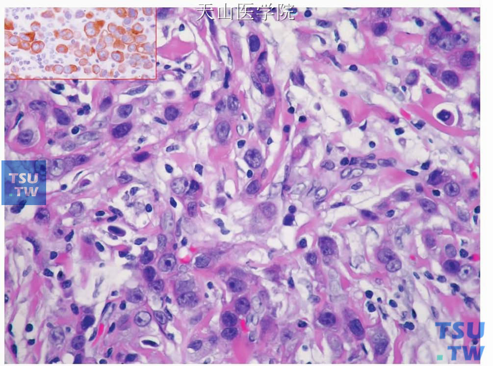大细胞癌：肿瘤细胞间较多纤维性间质，左上角插图示肿瘤细胞表达CK