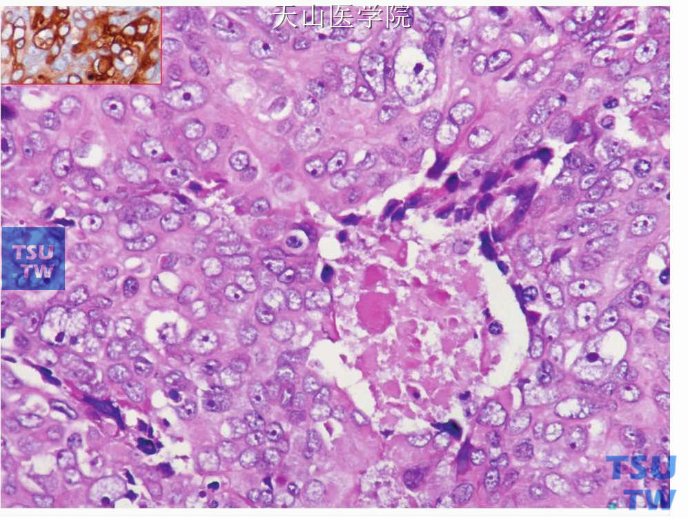 大细胞癌：肿瘤细胞体积大，有明显核仁，可见区域性坏死。左上角插图示肿瘤细胞表达CK
