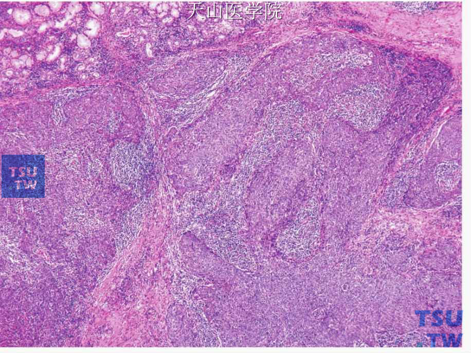 淋巴上皮癌：肿瘤形成较大的团片，间质内间大量的淋巴样组织