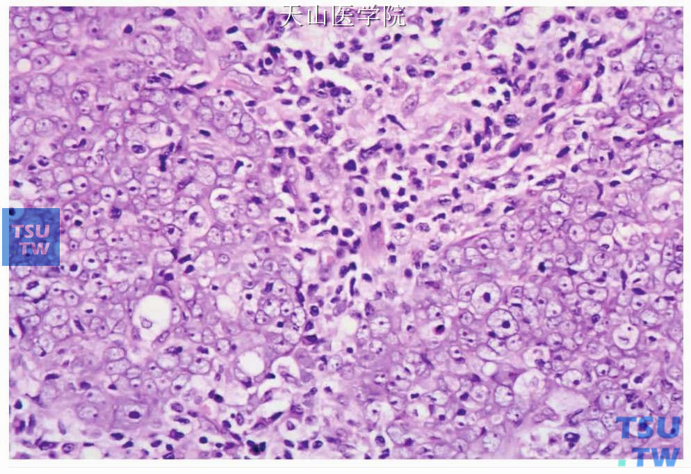 淋巴上皮癌：肿瘤细胞拥挤，可见细胞核重叠