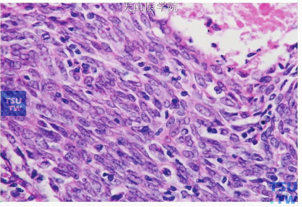 淋巴上皮癌：肿瘤细胞呈梭形。右上角可见坏死