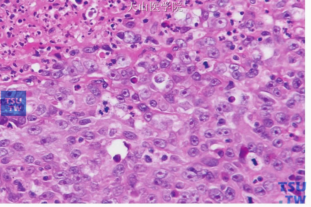 淋巴上皮癌：肿瘤细胞的核分裂多见、坏死较明显