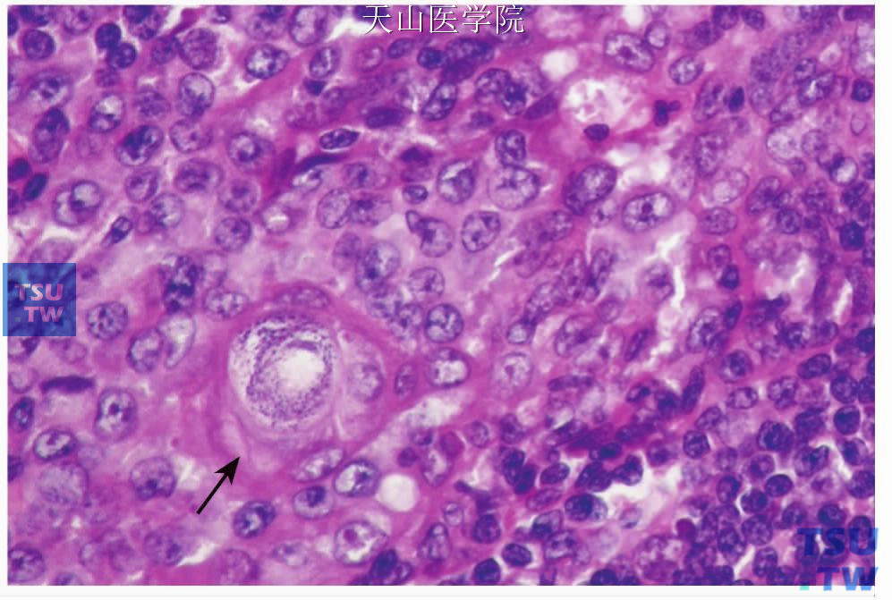 淋巴上皮癌：局部鳞状分化（箭头）
