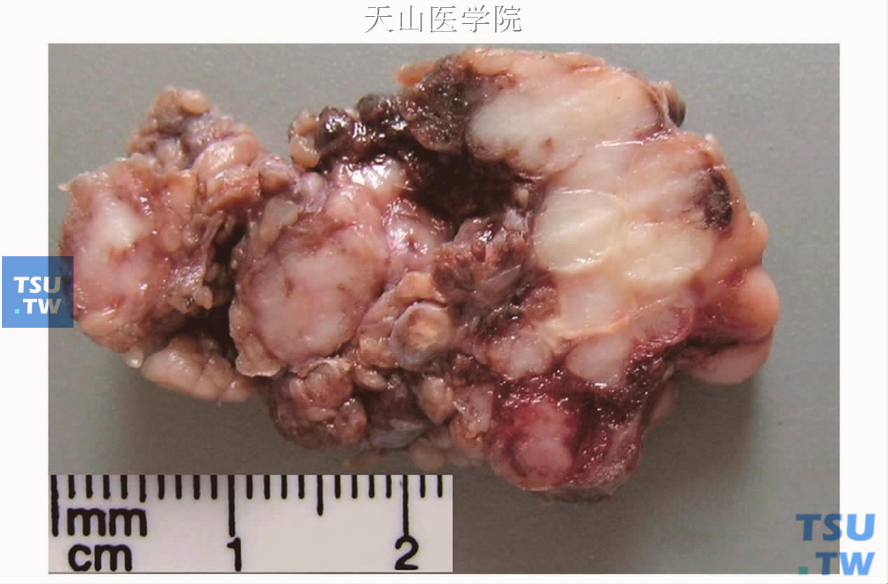 成涎细胞瘤：肿瘤大体标本成多结节样，切面灰白色（罗海燕分切、摄影）