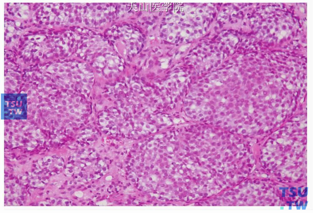 成涎细胞瘤：肿瘤细胞大小一致，成团排列