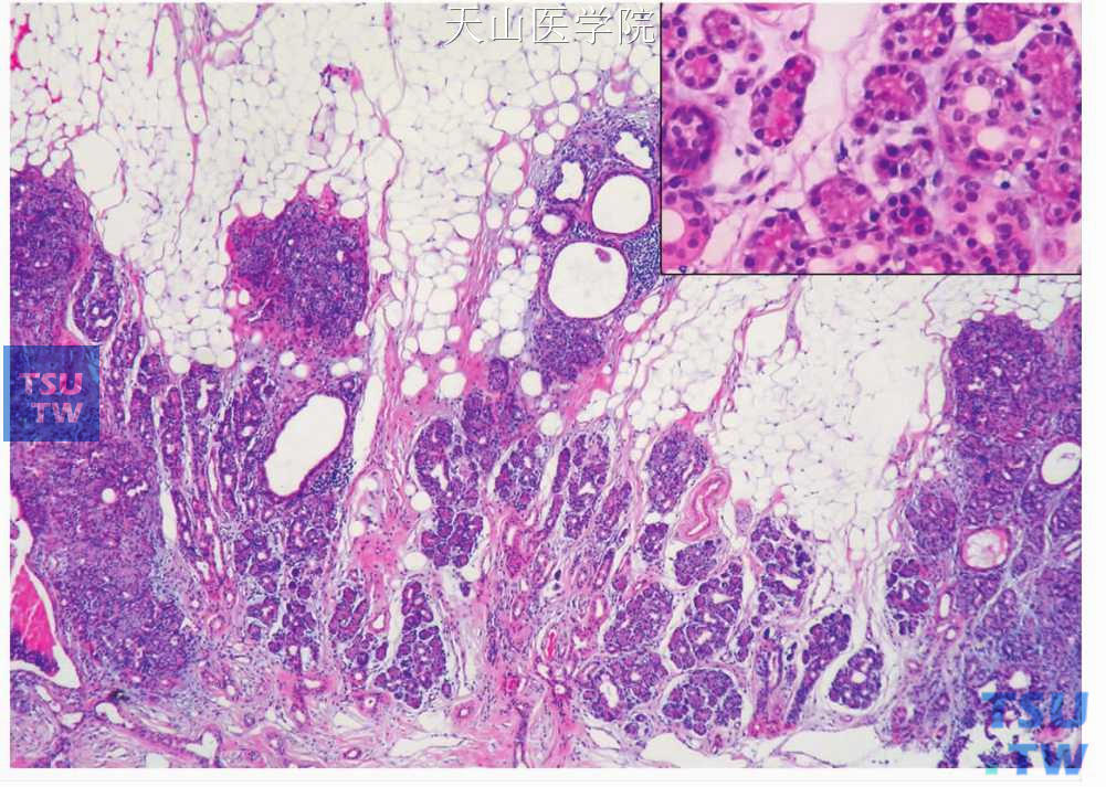 成涎细胞瘤：肿瘤周围腺体组织发育异常，有导管扩张、腺泡分化不成熟（插图）