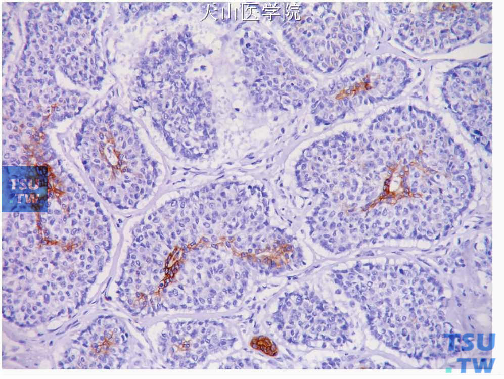 成涎细胞瘤：肿瘤细胞团中央的呈导管样分化的细胞表达CK，免疫组化染色