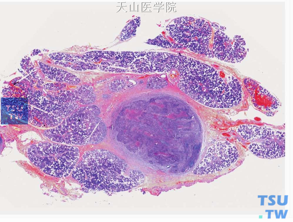 鼻咽癌转移至腮腺：表现为界限清楚的腮腺内肿物