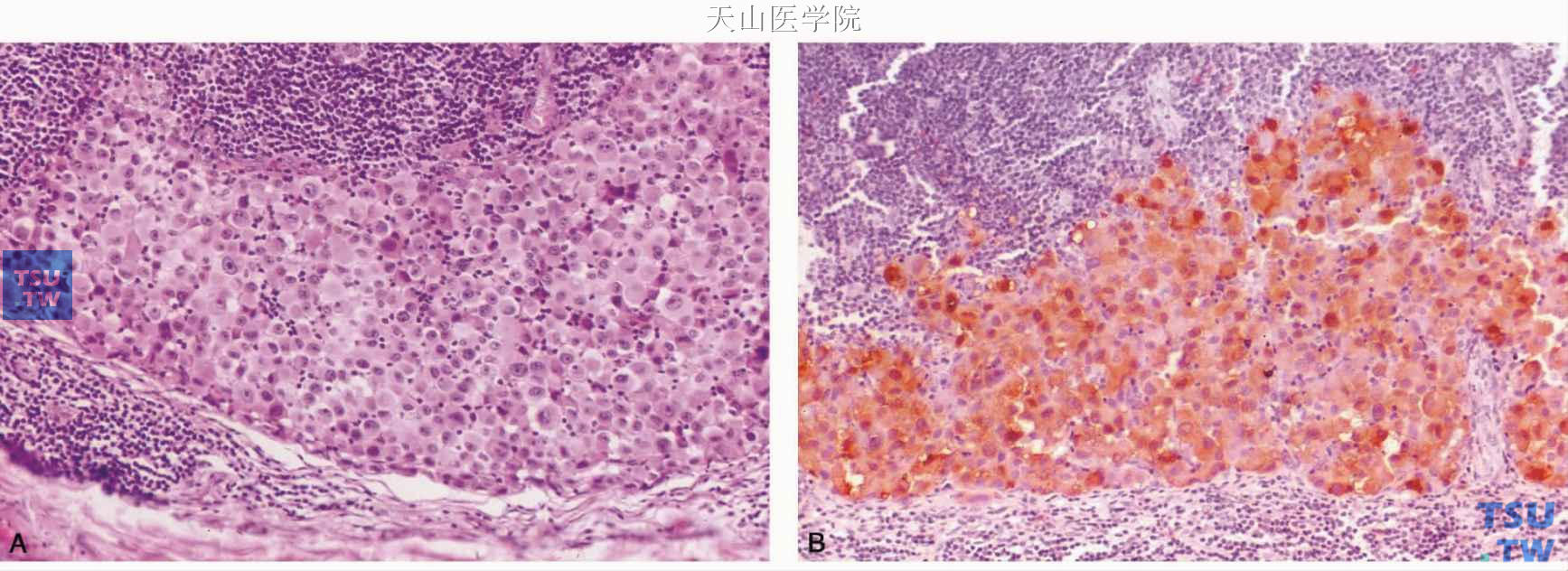 腮腺转移性黑色素瘤 A.耳廓黑色素瘤转移至腮腺淋巴结（左图）；B.肿瘤细胞HMB45免疫组织化学染色阳性