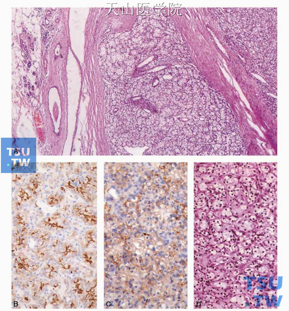 肾透明细胞癌腮腺转移 A.腮腺病变；B.腮腺病变肿瘤细胞表达CD10；C.腮腺病变肿瘤细胞表达波形蛋白；D.原发肿瘤（肾）的组织学表现