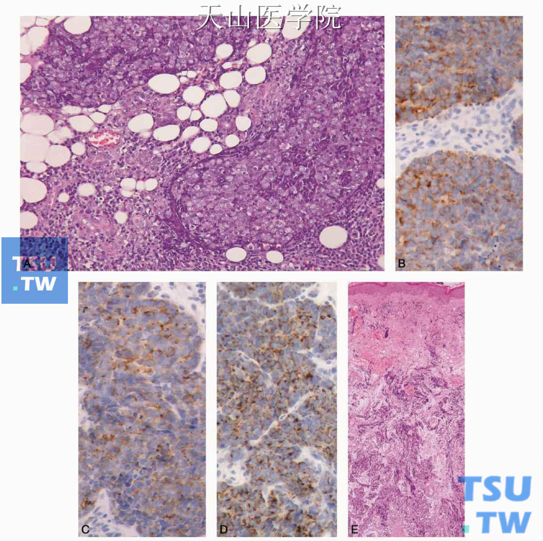 眼睑梅克尔细胞癌腮腺转移 A.腮腺病变；B.腮腺病变肿瘤细胞表达Syn；C.腮腺病变肿瘤细胞表达CgA；D.腮腺病变表达CK20；E.原发肿瘤（眼睑）的组织学表现