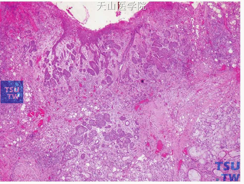 坏死性唾液腺化生：溃疡（上方）邻近的口腔上皮出现假上皮瘤样增生，深部可见小唾液腺的鳞状化生、腺泡的破坏、炎症和水肿