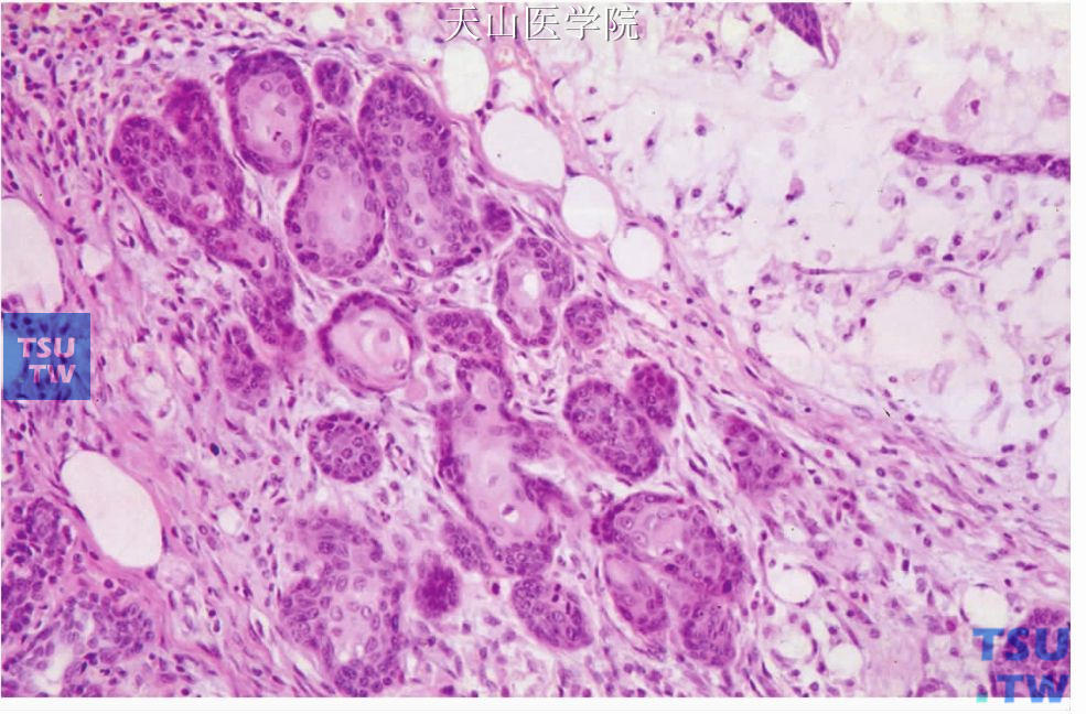 化生性唾液腺化生：病变中的黏液池（右上角）