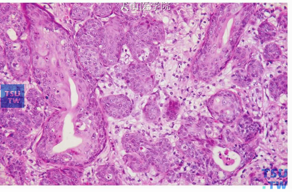 坏死性唾液腺化生：部分化生的细胞团中见导管的腔面结构