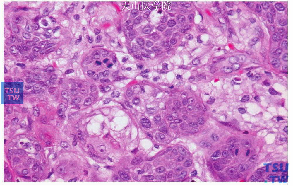 坏死性唾液腺化生：化生的细胞团中可见较多的核分裂，但无病理性分裂