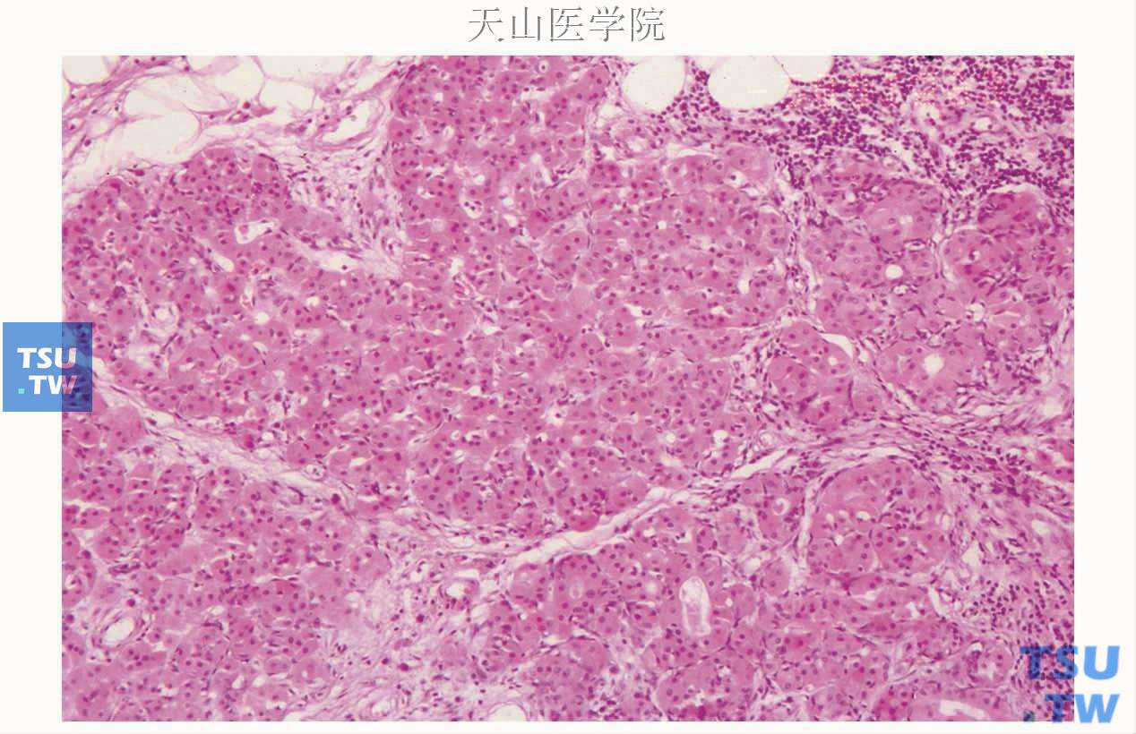 弥漫性嗜酸细胞增生症：整个腺小叶均发生嗜酸细胞变