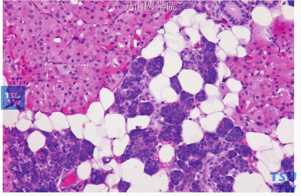 局灶性腺瘤样嗜酸细胞增生：腺体组织中出现多个嗜酸细胞结节