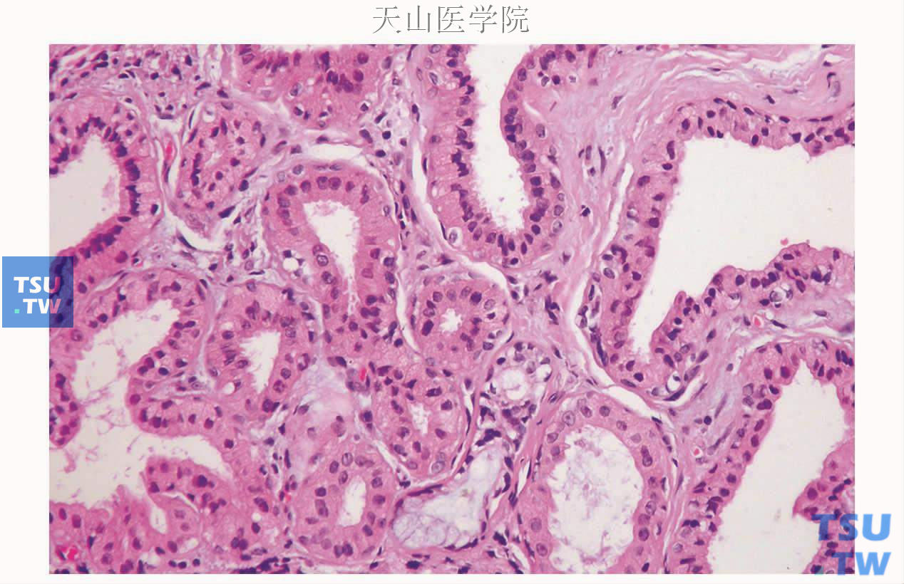 导管嗜酸细胞增生症：导管嗜酸细胞增生症伴导管扩张