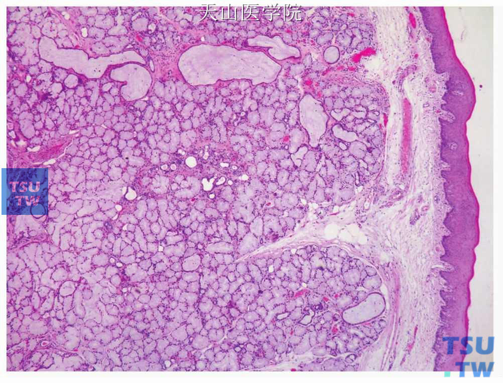 小唾液腺腺瘤样增生：结构正常的黏液腺形成小叶状结构，表面上皮完整