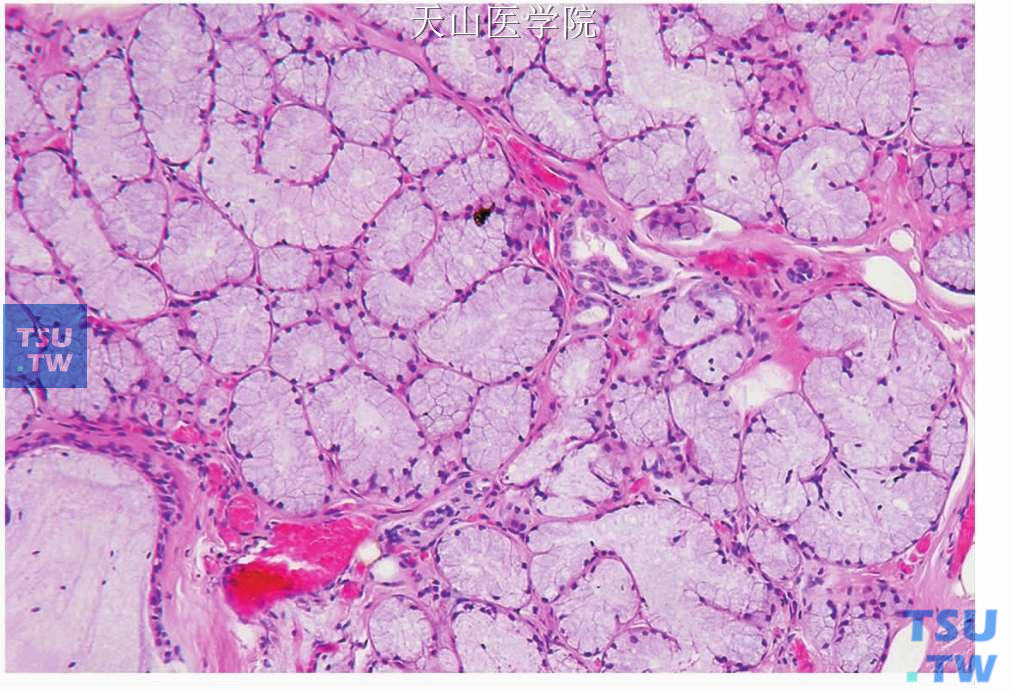 小唾液腺腺瘤样增生：结构正常的黏液腺腺泡，左下角可见扩张的导管