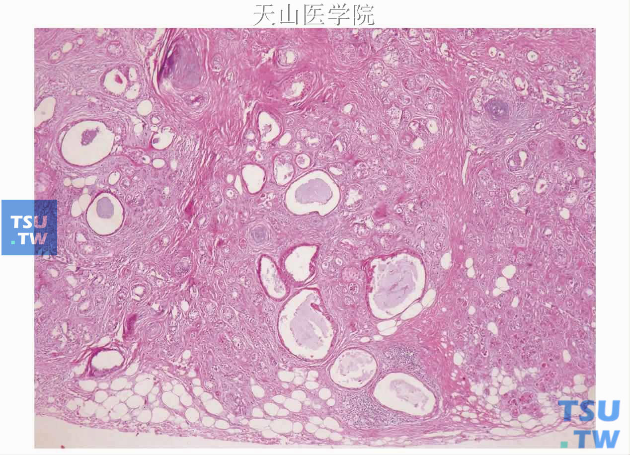 硬化性多囊性腺病：病变界限清楚，内见密集的胶原性结缔组织中由扩张的导管和腺泡等形成的模糊的小叶结构