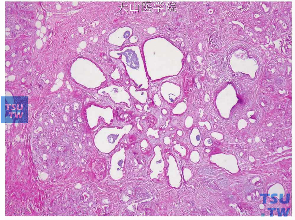 硬化性多囊性腺病（唾液腺瘤样病变的临床病理）