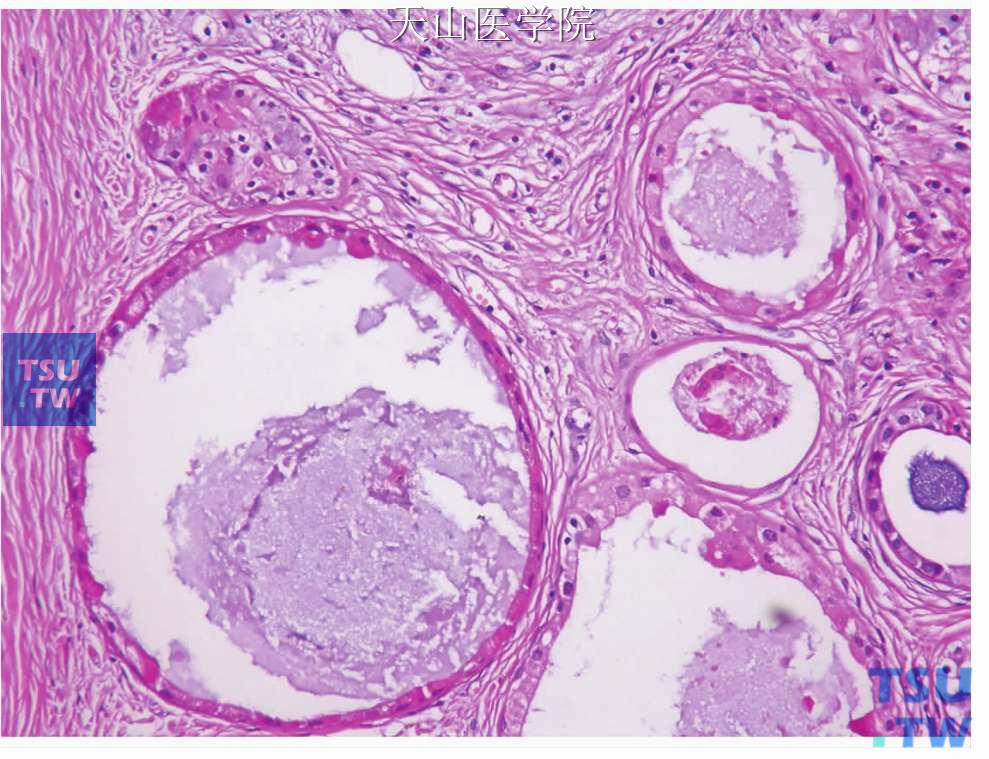 硬化性多囊性腺病：扩张的导管内衬单层低立方细胞