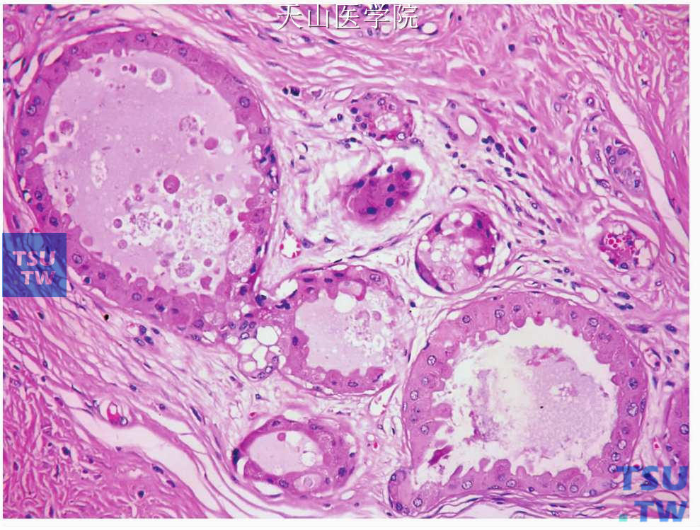 硬化性多囊性腺病：扩张的导管内衬顶浆分泌细胞