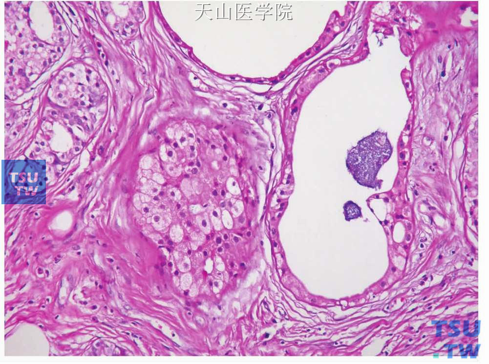 硬化性多囊性腺病：扩张的导管内衬顶皮脂样细胞