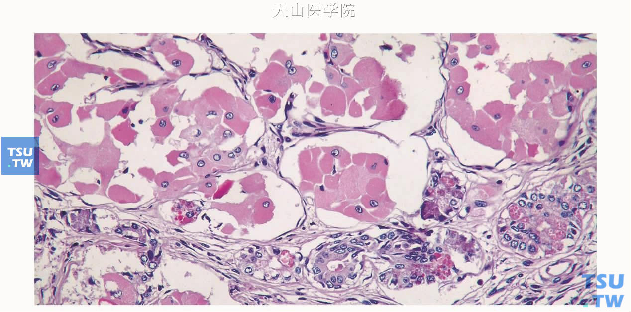 硬化性多囊性腺病：病变中的嗜酸性细胞