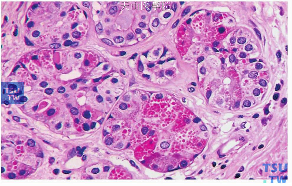 硬化性多囊性腺病：部分腺泡样细胞胞质内含粗大的嗜酸性颗粒