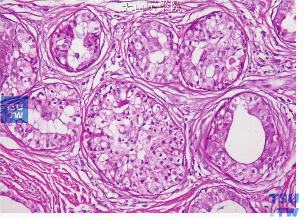 硬化性多囊性腺病：导管上皮增生，细胞层次增加