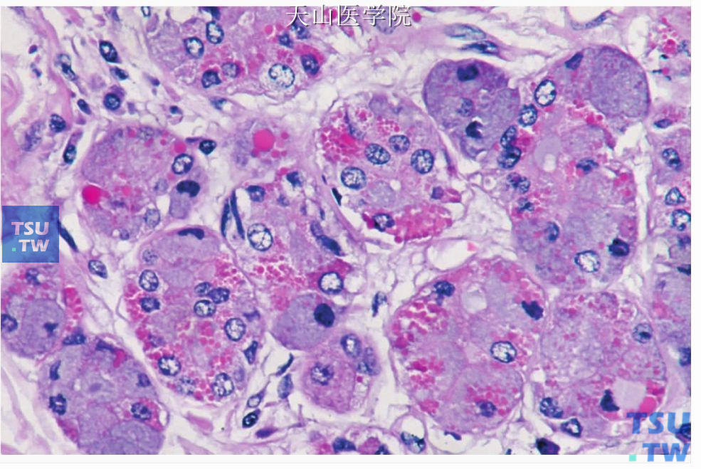 硬化性多囊性腺病：腺泡细胞增生