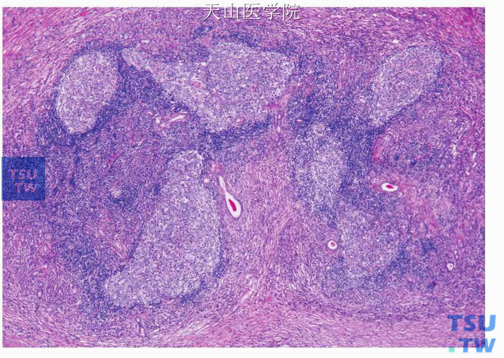慢性硬化性唾液腺炎：浸润的淋巴细胞形成淋巴滤泡，反应性生发中心呈地图样，间质纤维化明显，腺泡消失