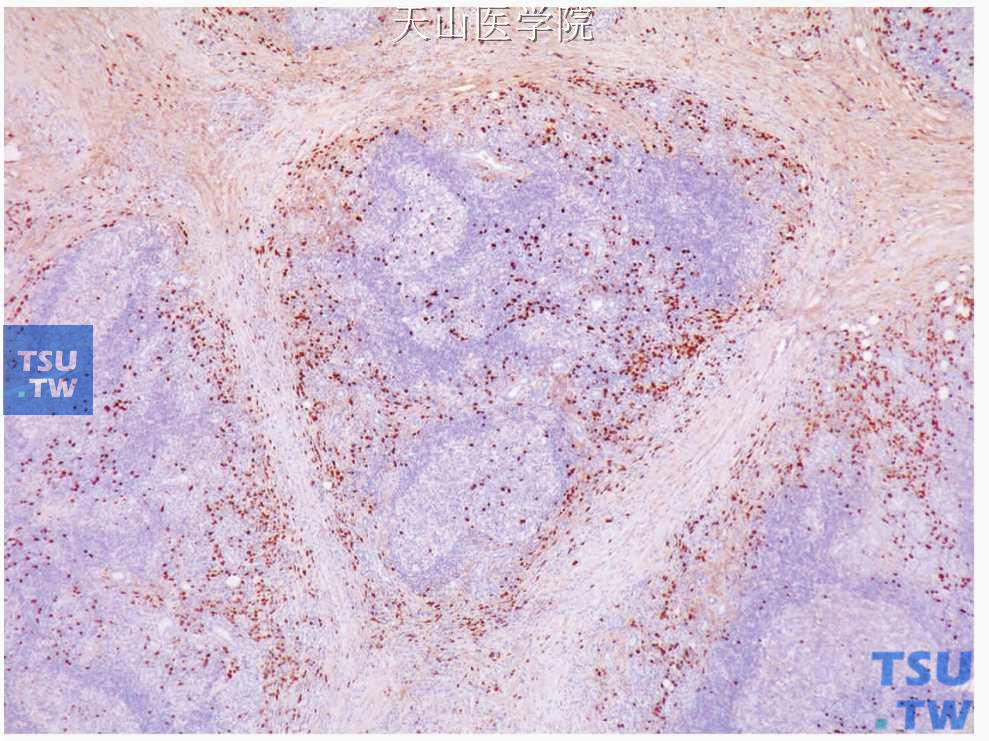 慢性硬化性唾液腺炎：IgG4阳性浆细胞的分布（免疫组织化学染色）