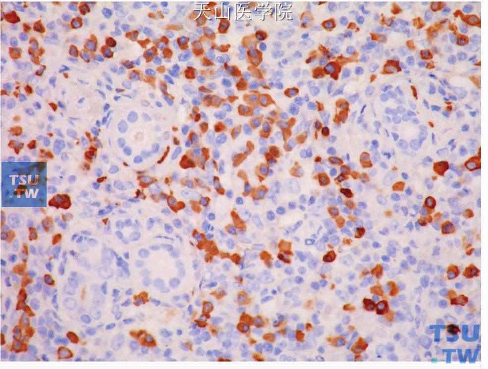 慢性硬化性唾液腺炎：IgG4阳性浆细胞在腺实质中浸润