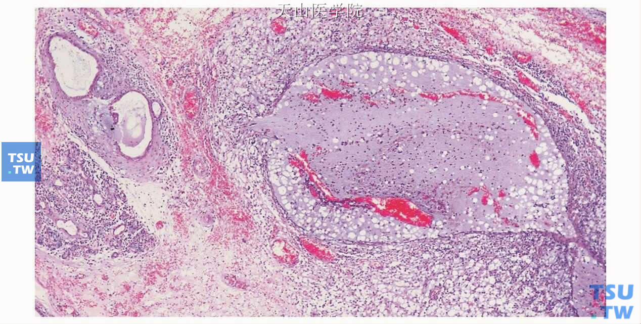 外渗性黏液囊肿：病变中即有肉芽组织包绕黏液的囊腔，同时组织间隙中也存在弥漫的黏液外渗的现象