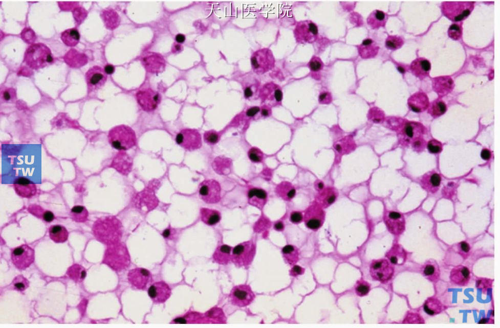外渗性黏液囊肿：囊腔内吞噬黏液的巨噬细胞呈泡沫状