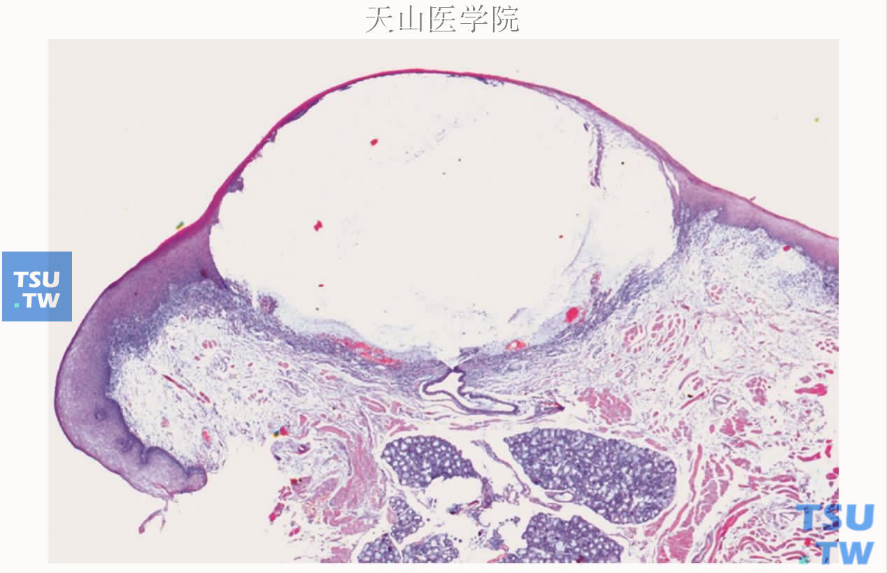 外渗性黏液囊肿：囊肿在上皮下方形成，表面上皮很薄