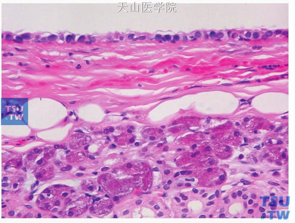 唾液腺导管囊肿（腮腺）囊肿内衬立方上皮