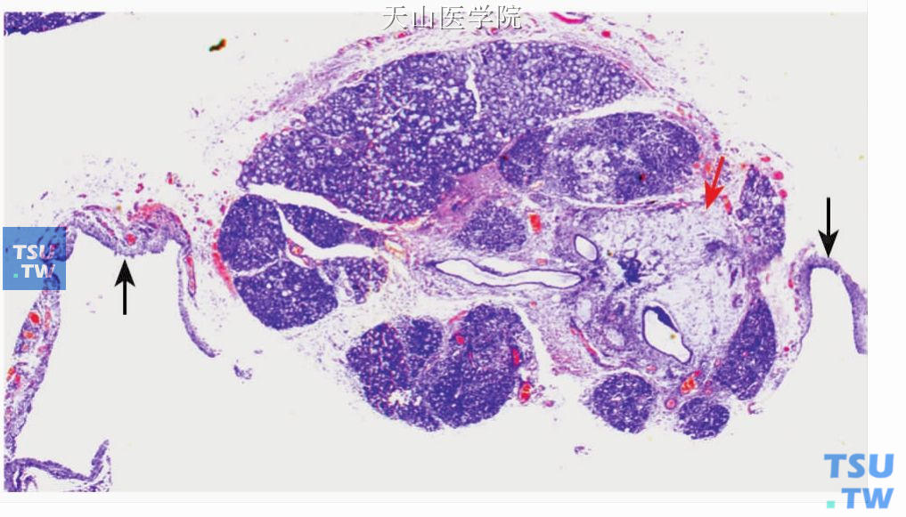 舌下囊肿：黏液外渗性，黏液在腺小叶间聚集（红色箭头），并且形成囊腔（黑色箭头）