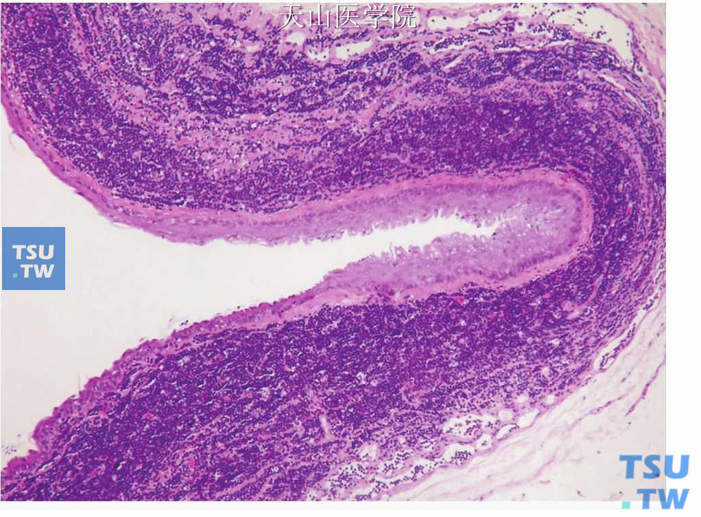 腮腺淋巴上皮囊肿：囊壁内衬复层鳞状上皮，囊壁中为大量的淋巴样组织