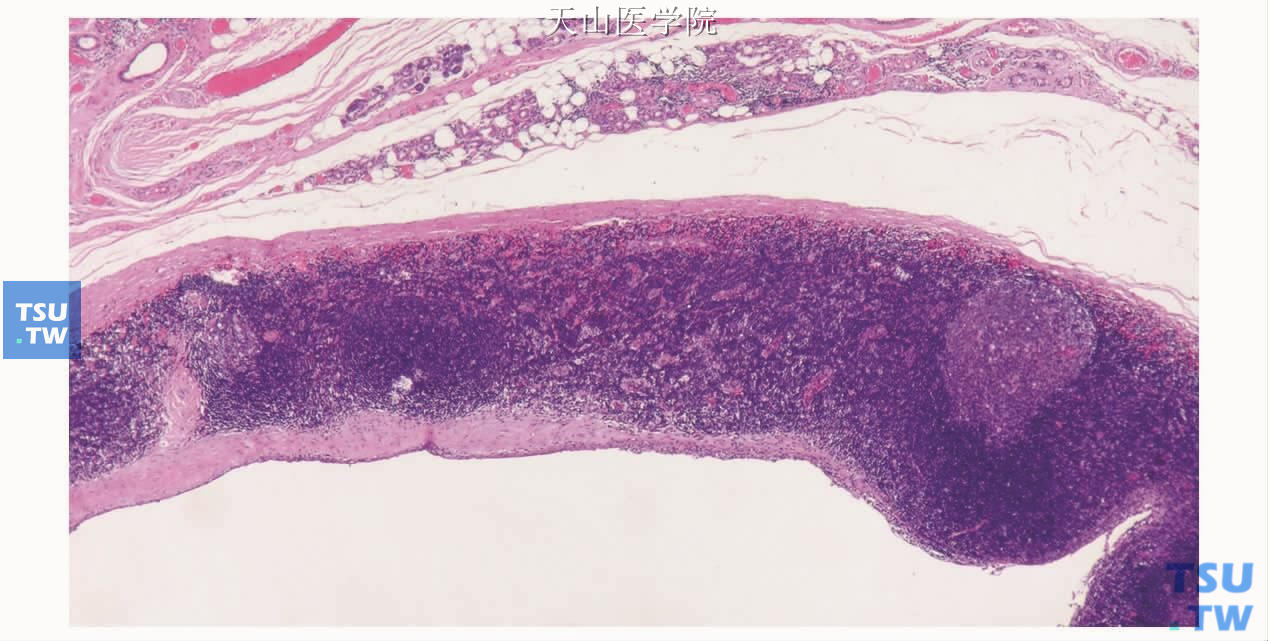 腮腺淋巴上皮囊肿：内衬上皮与淋巴样组织间有胶原带相隔，囊壁淋巴样组织中见淋巴滤泡