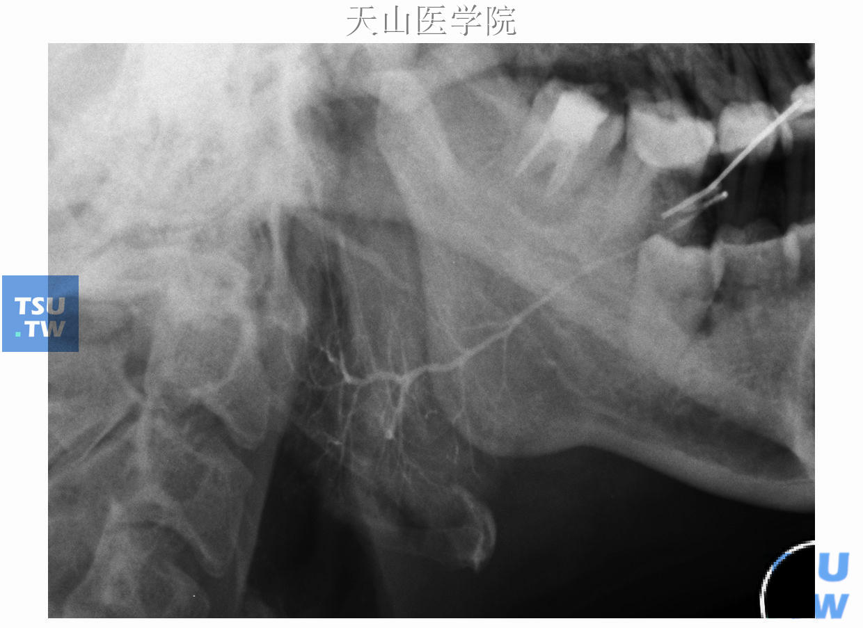 左腮腺造影侧位，主导管自腮腺导管口斜向后下方，越过下颌升支，逐级分支，逐渐变细，腺泡充盈呈云雾状