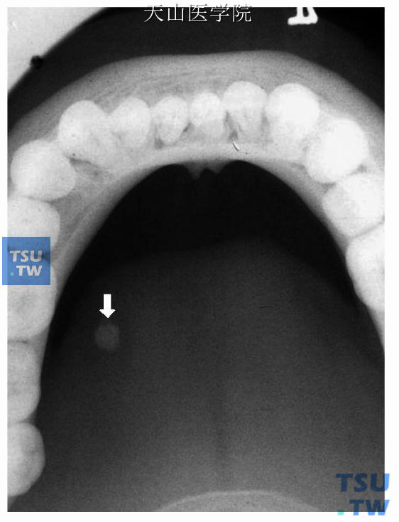 右下颌下腺导管阳性结石，下颌横断咬合片可见右下颌下腺导管走行区一圆形高密度影（↑）